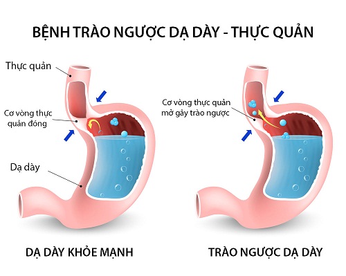 trao-nguoc-da-day-axit