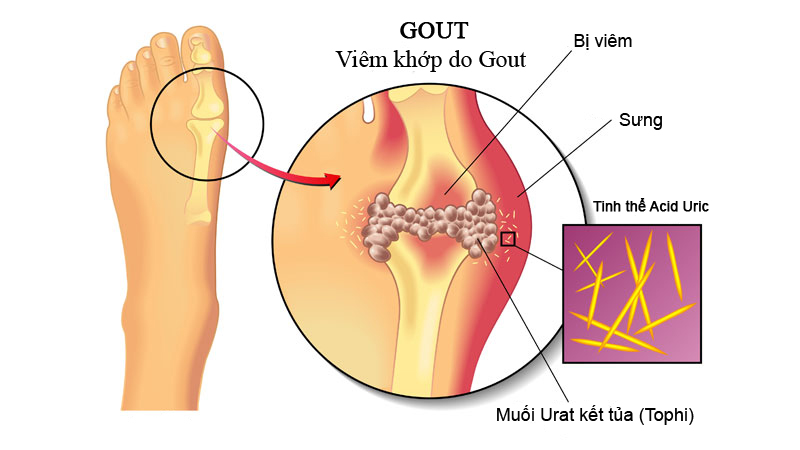 Các bài thuốc dân gian giúp đẩy lùi bệnh gút Các bài thuốc dân gian giúp đẩy lùi bệnh gút